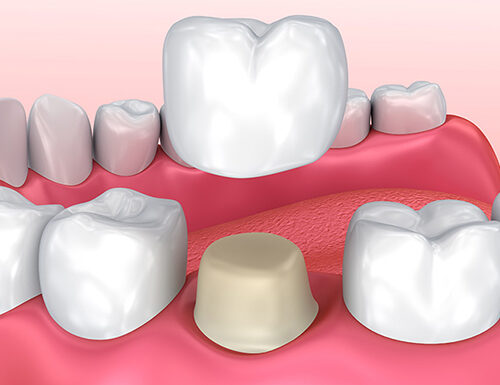 The Impacted Wisdom Tooth