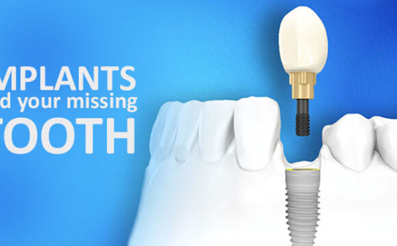 Implants and your Missing Tooth