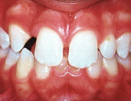 Hypodontia / Congenitally Missing Teeth
