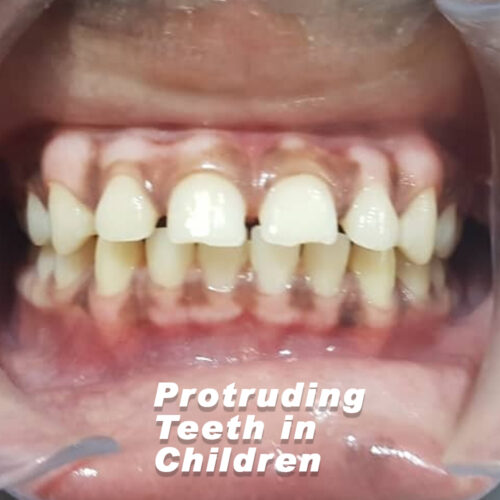 Protruding Teeth in Children