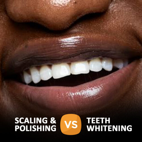 Scaling And Polishing VS Teeth Whitening